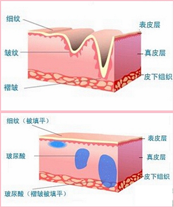 玻尿酸除皱