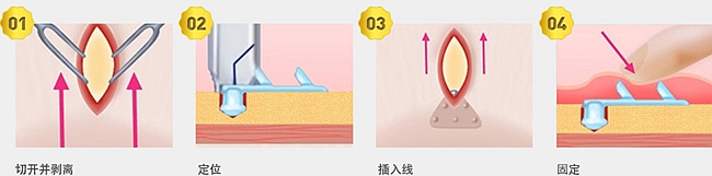 韩国整形医院的埋线提升术是什么？