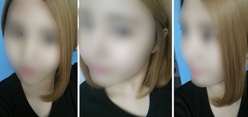 开眼角+面部轮廓手术 终于解救了我的四方脸