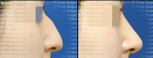 韩国BK整形医院鼻整形案例