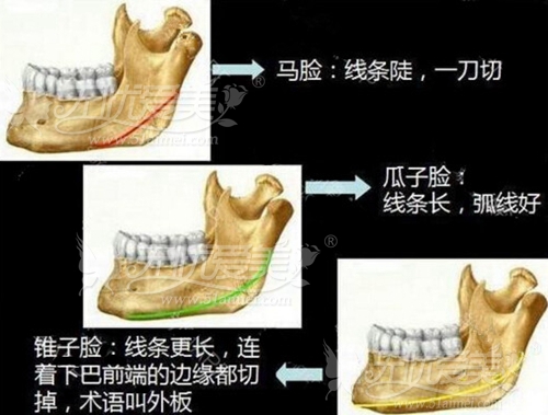 下颌骨整形线条