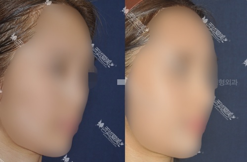 韩国4月31日鼻部整形案例