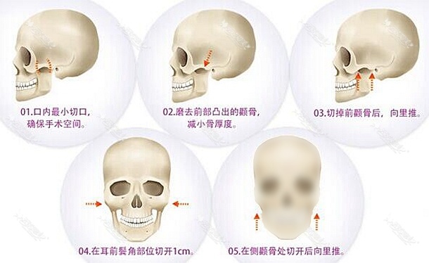 刘成胜改脸型