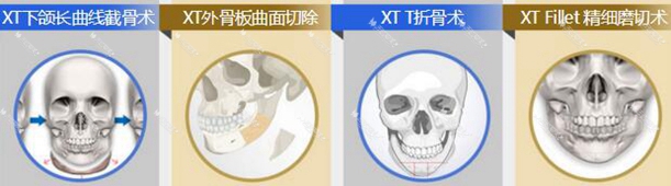 张笑天面部轮廓整形