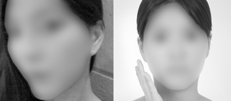 眼鼻整形+面部轮廓手术前