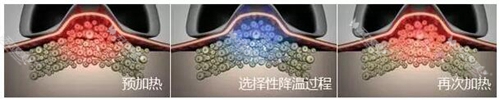 冷冻溶脂瘦身治疗的3个阶段