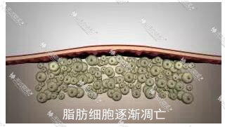 冷冻溶脂后脂肪细胞逐渐死亡
