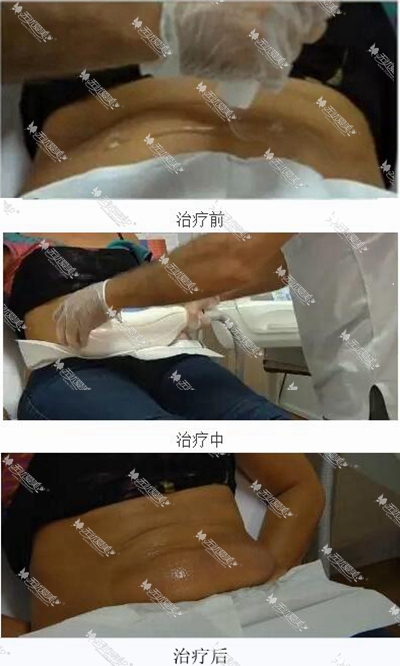 冷冻溶脂瘦身效果