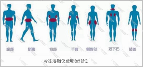 冷冻溶脂治疗部位