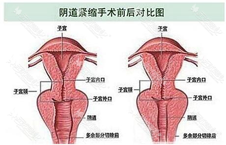 阴道紧缩术