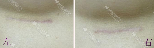 韩国假体隆胸术后三个月疤痕恢复