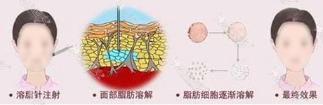 溶脂针瘦脸