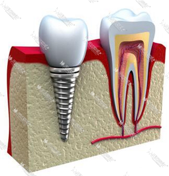 种植牙