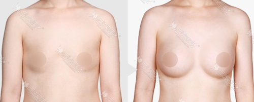 韩国TL整形医院假体隆胸整形案例