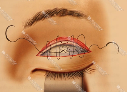 韩国双眼皮手术过程