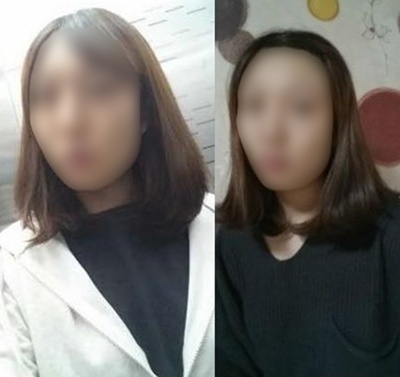 面部轮廓+眼鼻整形后 从土妞变气质女神