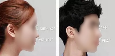 鼻子整形分男女 韩国隆鼻手术揭秘