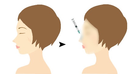 韩国玻尿酸隆鼻