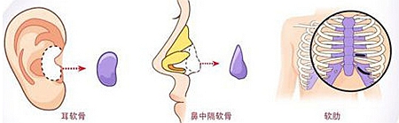 韩国自体软骨隆鼻手术