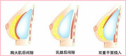 常见隆胸假体植入层次