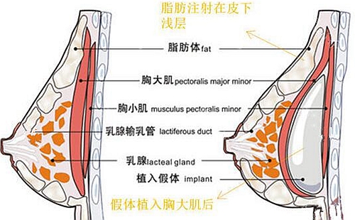 假体和自体脂肪隆胸的层次