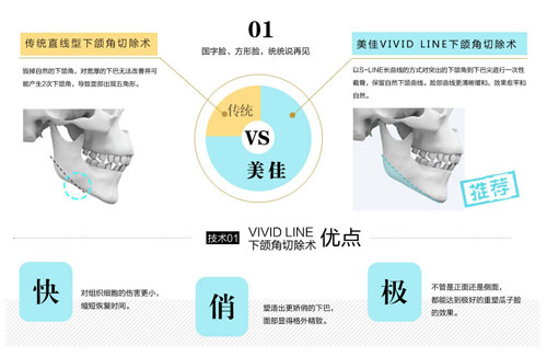 韩国美佳下颌角整形