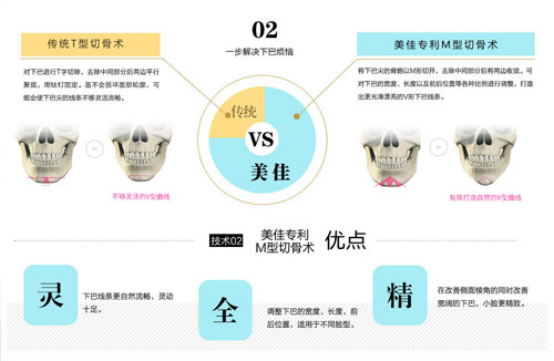 韩国美佳面部切骨术