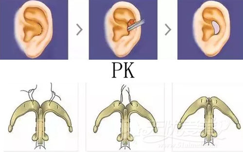 耳软骨pk鼻中隔软骨