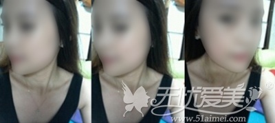 贝丽在韩国双颚手术+鼻整形手术后1个月