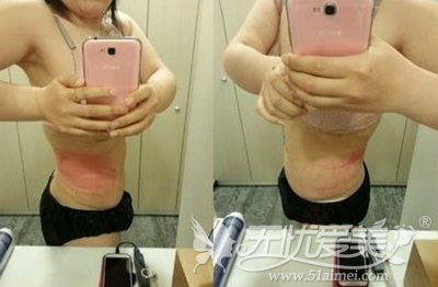 冷冻溶脂术后2个月的照片