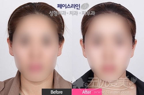 韩国面部轮廓手术案例
