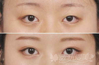 双眼皮+开眼角术后半年