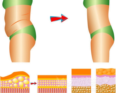 吸脂手术后皮肤会松弛吗