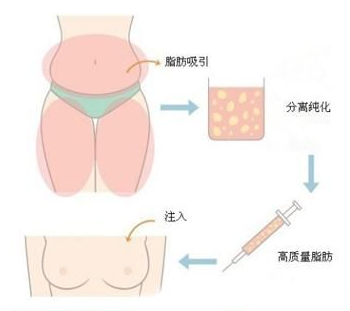 广州军美93%存活率新微度自体脂肪丰胸术