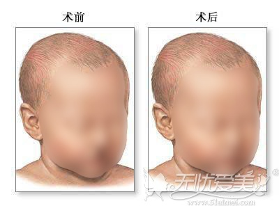 唇裂修补术的效果对比图