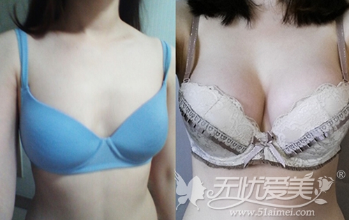 韩国麦恩整形外科李圣郁院长假体隆胸案例