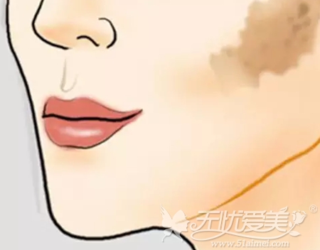 咖啡斑的分类及治疗 咖啡斑的分类及治疗