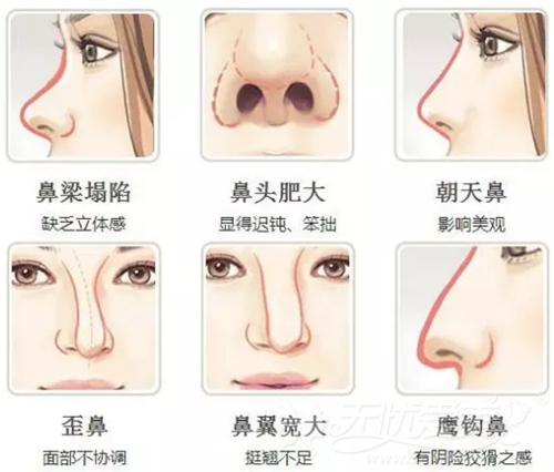 韩国线雕隆鼻适合的鼻型