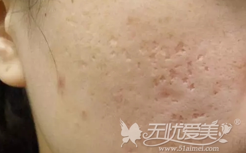 皮肤常见的凹陷型疤痕