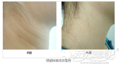 激光去除颈纹前后对比案例