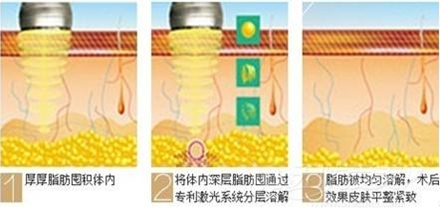 光纤溶脂减肥原理