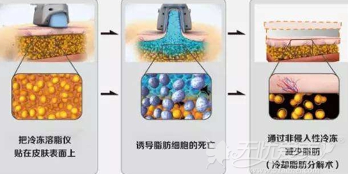 韩国冷冻溶脂瘦身原理