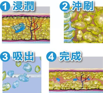 韩国吸脂手术原理