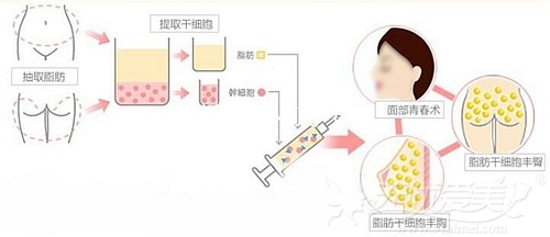 韩国脂肪移植部位