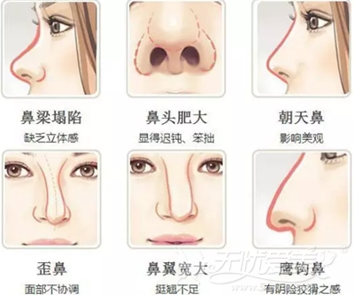 适合进行韩式隆鼻手术的鼻型