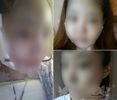秀雅在韩国TL整形医院面部轮廓+脂肪填充后1-7天