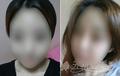 秀雅在韩国TL整形医院面部轮廓+脂肪填充后2周