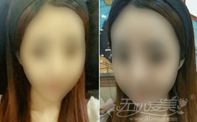 秀雅在韩国TL整形医院面部轮廓+脂肪填充后1个月