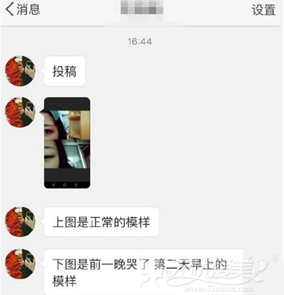 哭多了没有变双眼皮