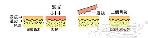 激光祛斑作用效果